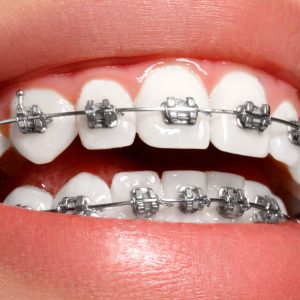 brackets-ortodoncia-dr-gallardo-ortodoncistajaen